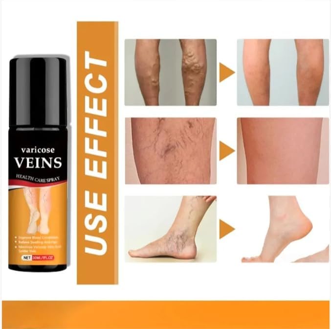 Al Varicose Veins Spray – Natural Herbal Formula for Fast Relief | Reduces Swelling, Relieves Pain & Promotes Blood Circulation | Easy-to-Use Spray for Legs, Ankles & Feet  buy 1 get 1 free